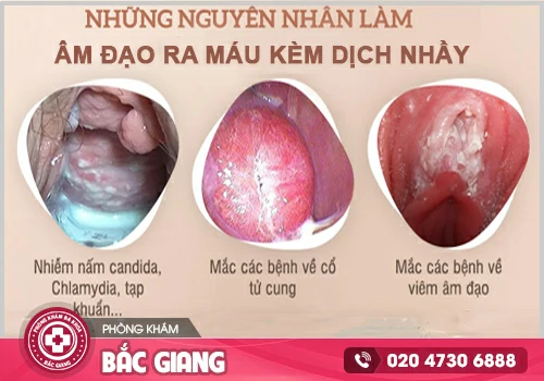 Máu báo thai có dịch nhầy không? Xem ngay để giải đáp