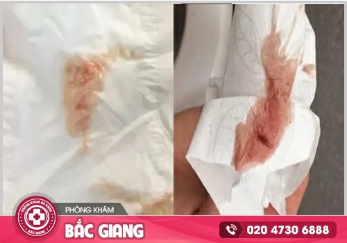 Máu báo thai màu gì? Phân biệt với máu kinh