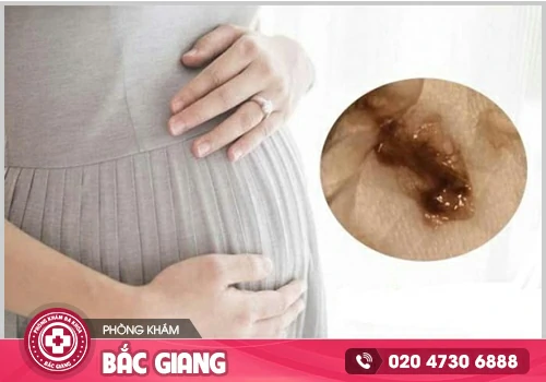 Máu nâu có thai có phải là triệu chứng cảnh báo bệnh lý?