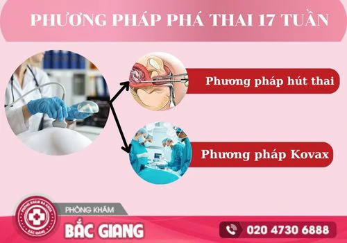 phá thai 17 tuần