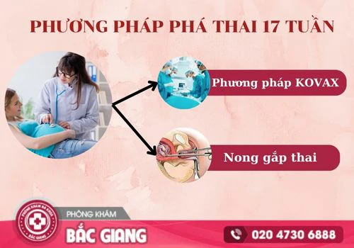 Các phương pháp phá thai 17 tuần an toàn hiện nay. phá thai 17 tuần bao nhiêu tiền