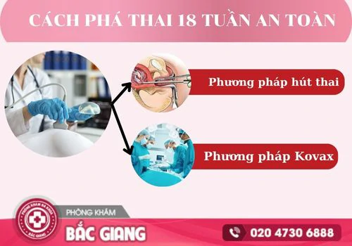 phá thai 18 tuần