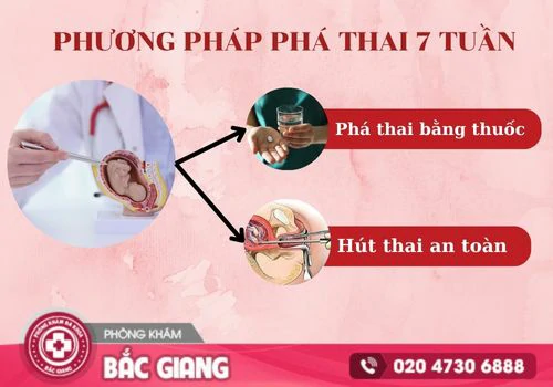 phá thai 7 tuần